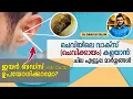 1063: 👂 ചെവി എങ്ങനെ വൃത്തിയാക്കാം? ചെവി വൃത്തിയാക്കാൻ ബഡ്സ് ഉപയോഗിക്കാമോ ? How to clean ears?