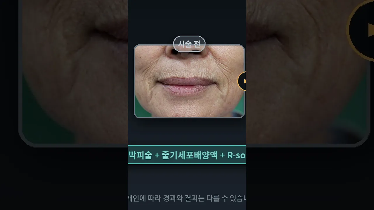 인중 세로주름 박피술 실제 경과 | 2주 · 2개월 1주 비교 (60대 중반) #연세자연미#인중주름 #인중세로주름 #입술주름 #입가주름 #박피술