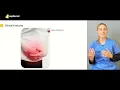 Mesenteric Ischaemia | Diagnosis