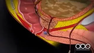 Prostate Cancer Labelled 3D Medical Animation ABP 