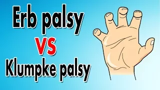 Erb s Palsy vs Klumpke s Palsy
