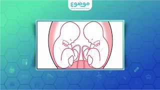 كيف اعرف اني حامل بتوأم 