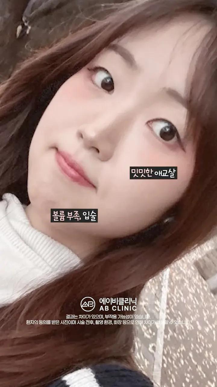 애교필러, 입술필러 직후 효과