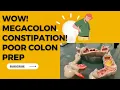 Intractable Constipation or Colonoscopy Preparation Was Poor You May Have MEGACOLON