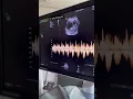 Download Lagu HEARING BABIES HEARTBEAT FOR THE FIRST TIME- 11 WEEKS PREGNANT