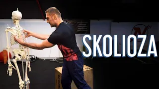 skolioza przyczyny rokowania terapia