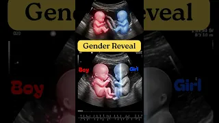 Amazing Gender Reveal in Pregnancy Twins Ultrasound