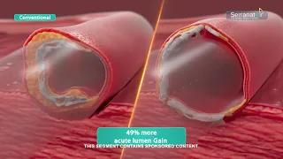 New Tech from Cagent Vascular brings Serrated Edge to Vascular Care