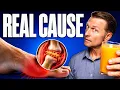 The Best Protocol to Reverse Gout Prevent It