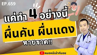 ควรใช้สบู่ประเภทใดเพื่อลดอาการผื่นคัน