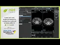 Create your own Reading Templates with the new Template Editor in mint Lesion