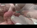 Mr Wilson s Blackhead Extractions