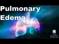 Nursing Emergencies Pulmonary Edema