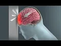 How Traumatic Brain Injury TBI Affects Brain Cells - New Research Could Lead to New Treatments