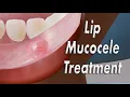 Inner Lip Mucocele Inside Lip Bump Surgical Treatment