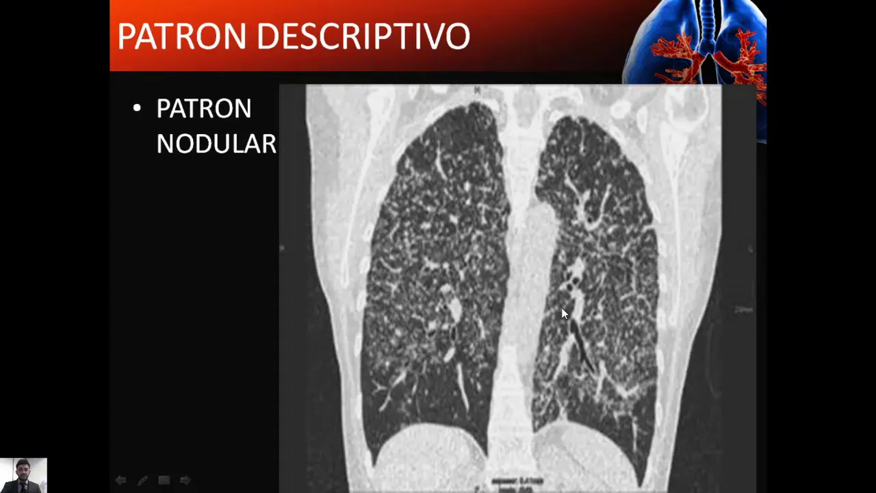 Neumopatías intersticiales idiopáticas - Dr. Patricio Chacón