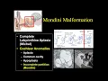 Suresh Mukherji Pre-op Imaging of Cochlear Implants