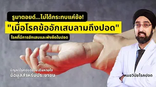 การรักษาพังผืดปอดที่เกิดจากโรครูมาตอยใช้วิธีใดบ้าง