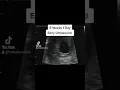 Download Lagu Heartbeat on Early Ultrasound at 6 Weeks 1 Day Pregnant