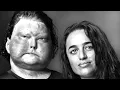 Face Transplant Patient and Wife-Joe and Jessica Dimeo