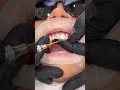 Composite bonding by Dr Matt