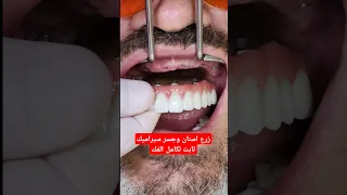 زرع اسنان وجسر سيراميك ثابت لكامل الفك دندنها
