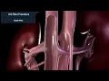 Inferior vena cava filter procedure