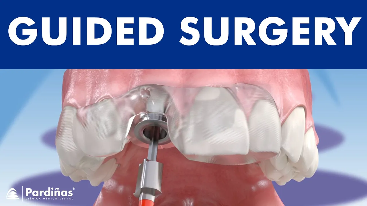 Outline Video Guided implant surgery ©