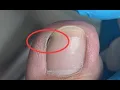 Download Lagu Nails are not cleaned properly and dirt is hidden