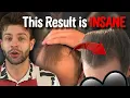This is How These Reddit Users Finally Regrew Their Hair