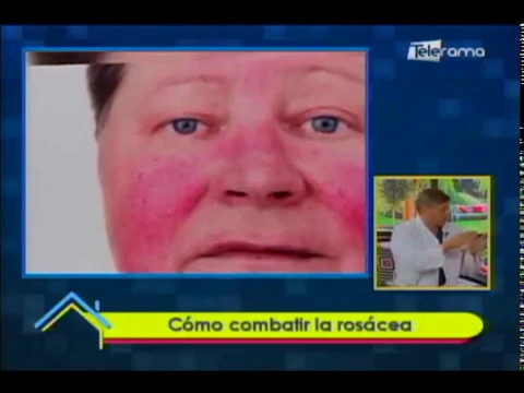 Cómo combatir la rosácea