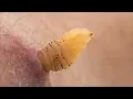 Download Lagu Researcher raises botflies under his skin I NOVA I PBS