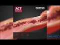 Download Lagu Rossmax Artery Check Technology (ACT) - Solmed Pty Limited