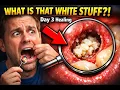 tooth Extraction Healing Timeline Day 1 to 7 Pictures Is White Tissue Normal