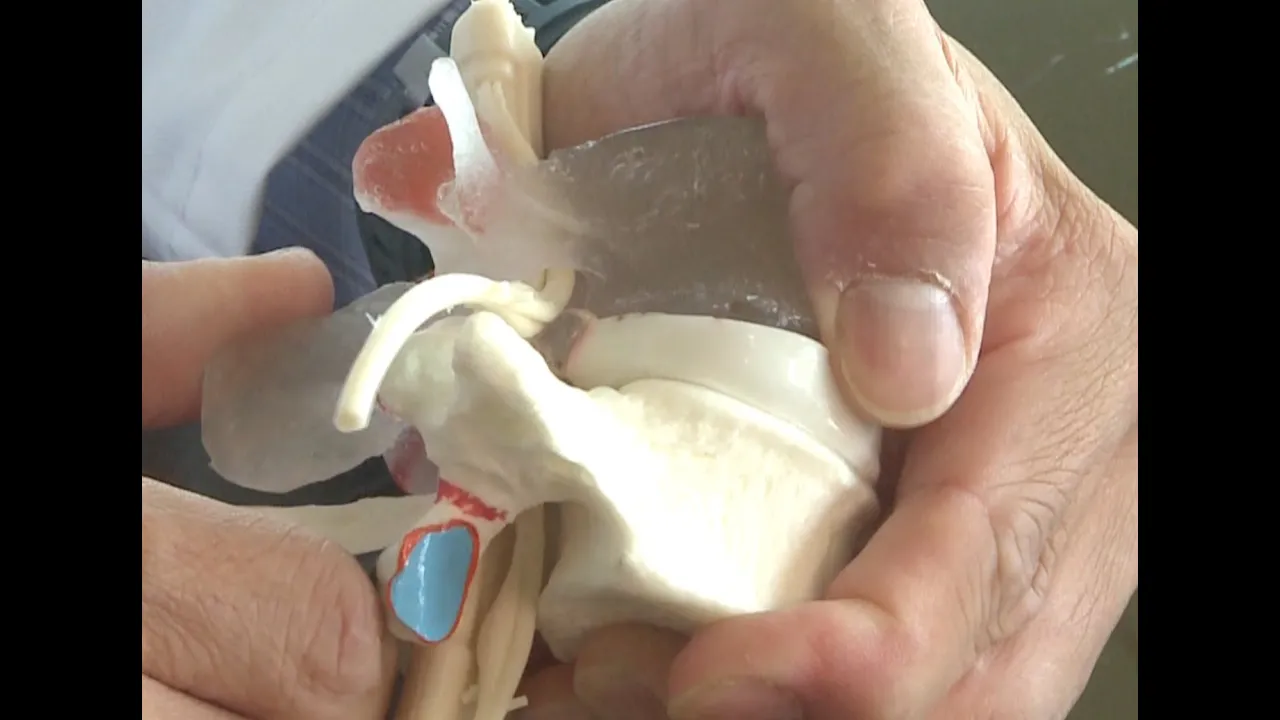 Donald Corenman MD demonstrates a surgical removal of a far lateral disc herniation in the lumbar sp. 