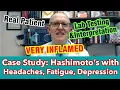 Case Study Hashimoto s with Headaches Fatigue Depression -