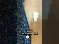 Deze pacemaker is slechts een paar milimeter groot