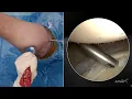 Download Lagu Posterior Instability With Knotless FiberTak® Soft Anchors Using Sequential Tensioning of the Repair
