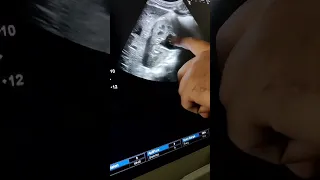 Ultrasound Evaluation Suggestive of Pyelonephritis with Pyonephrosis