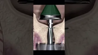 شوف كفاش إعادة غشاء البكارة 