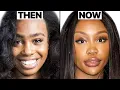 SZA New Face Plastic Surgery Analysis