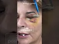 Download Lagu 100% o operație care transformă aspectul feței - Blefaroplastie superioară + inferioară [Dr. Levy]