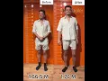 Download Lagu Before and after +9.5 cm more height #limblengthening #beforeafter #ozkansagin #gettaller #shorts
