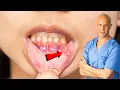 How I Quickly Healed My Canker Sore Dr Mandell