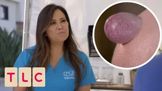 Man Hides Massive Forehead Bump For 25 Years Until Dr Lee Steps In Dr Pimple Popper