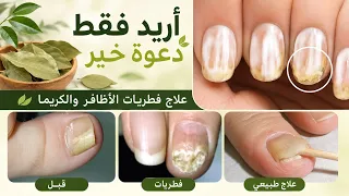 بعشبة واحدة علاج فطريات الأظافر والكزيما اريد فقط دعوة خير