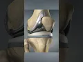 Download Lagu Total knee replacement (3D Animation)