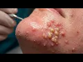 Loan Nguyen Acne Treatment 14zz