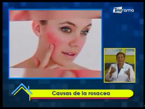 Causas de la rosacea