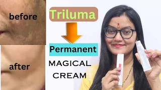 Triluma pigmentation cream permanent treatment